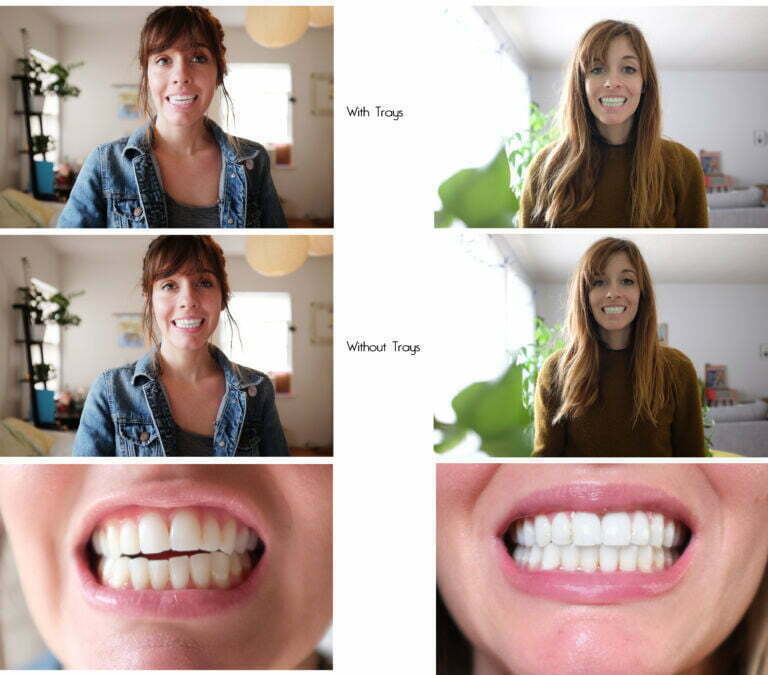 Before after with Invisalign