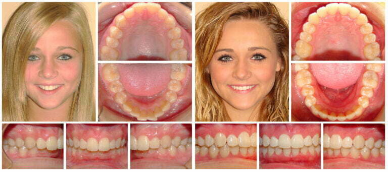 Cross bite   before and after Invisalign treatment