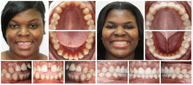 Gapped teeth   before and after Invisalign treatment