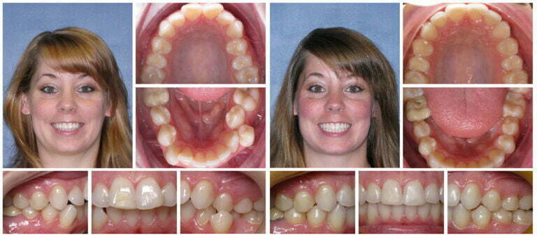 Cross bite  before and after Invisalign treatment