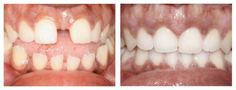gapped teeth before and after Invisalign treatment