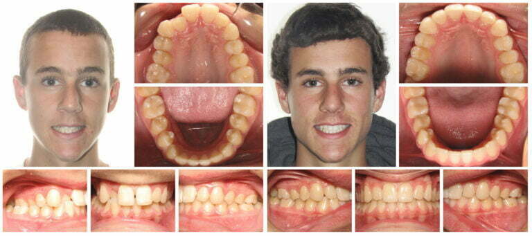 Over brite  before and after Invisalign treatment